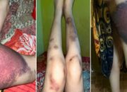 Dituduh Selingkuh, IRT Hamil di Bulukumba Ngaku Ditendang Suami Puluhan Kali